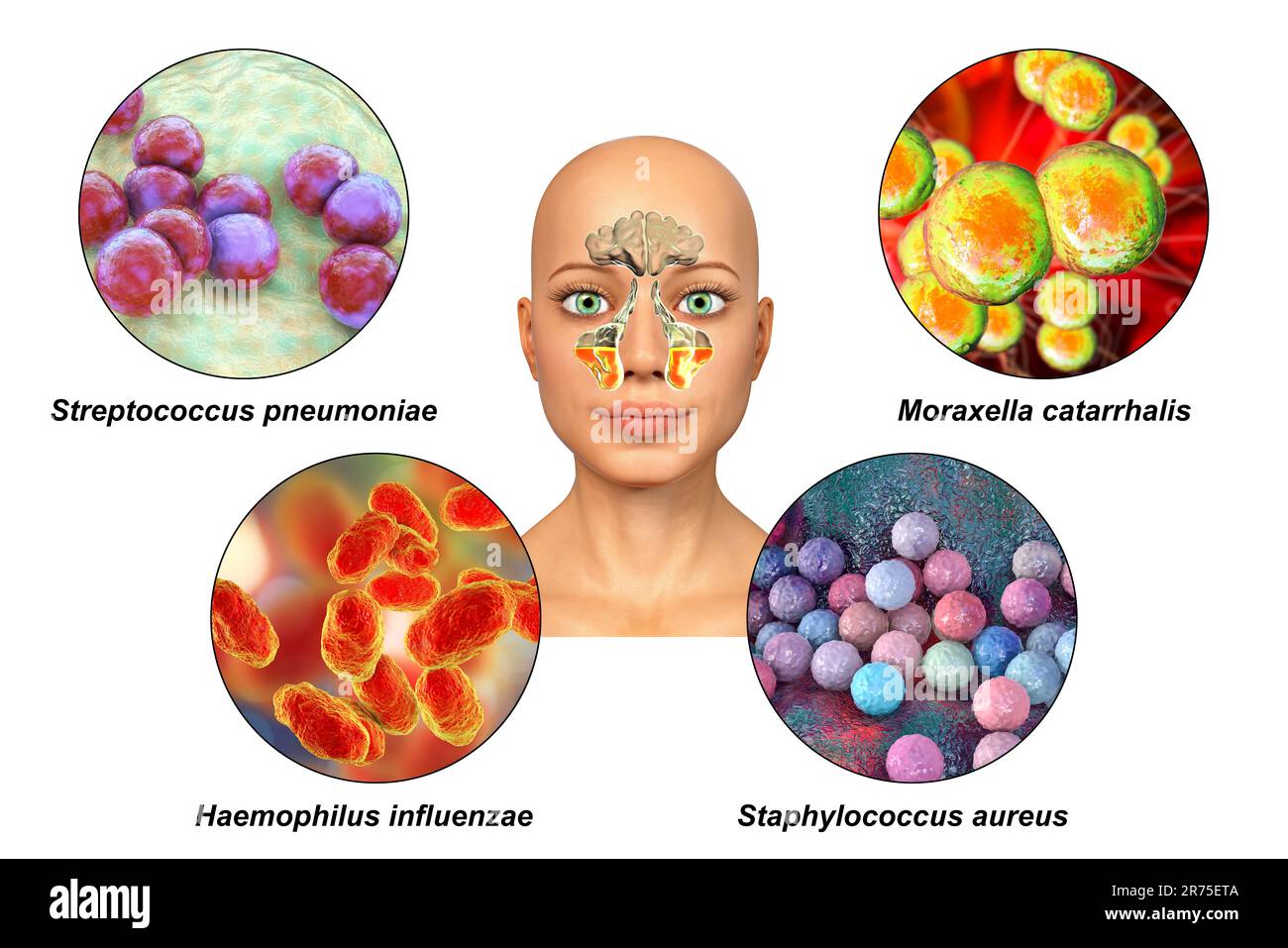 Anatomy of rhinosinusitis and bacteria that cause sinusitis. Streptococcus pneumoniae, Moraxella catarrhalis, Haemophilus influenzae, and Staphylococc Stock Photo