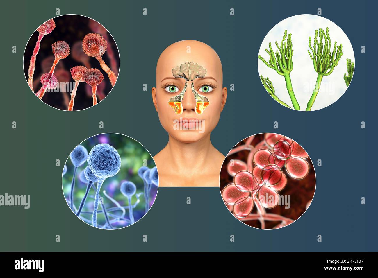 Fungi as a cause of sinusitis. Computer illustration showing
