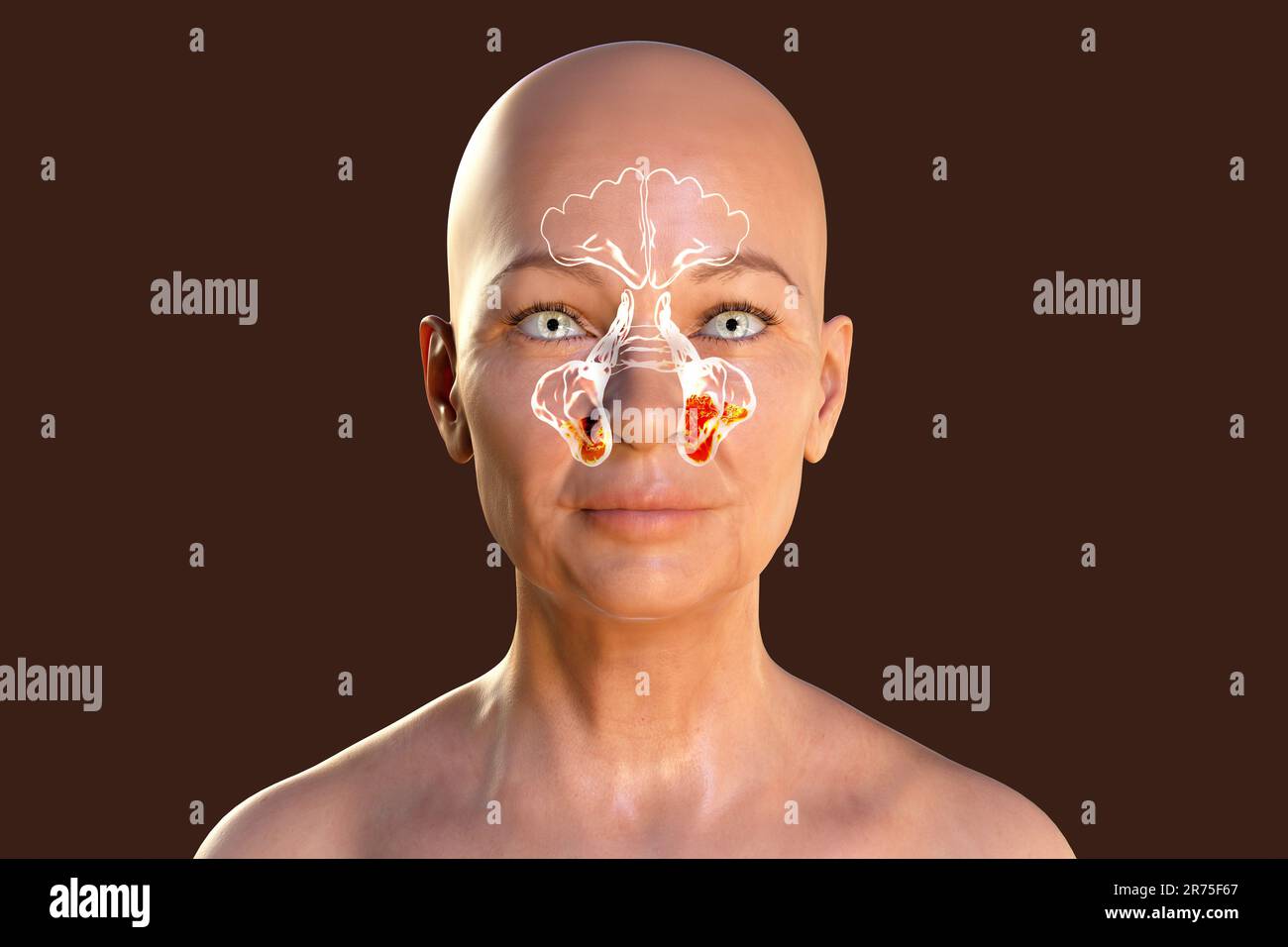 Sinus infection, or sinusitis, computer illustration. The sinuses are
