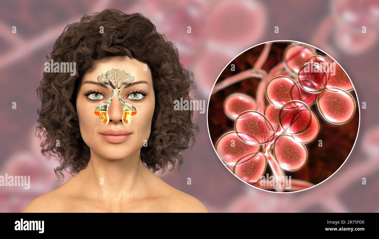 Candida fungi as a cause of sinusitis. Computer illustration showing