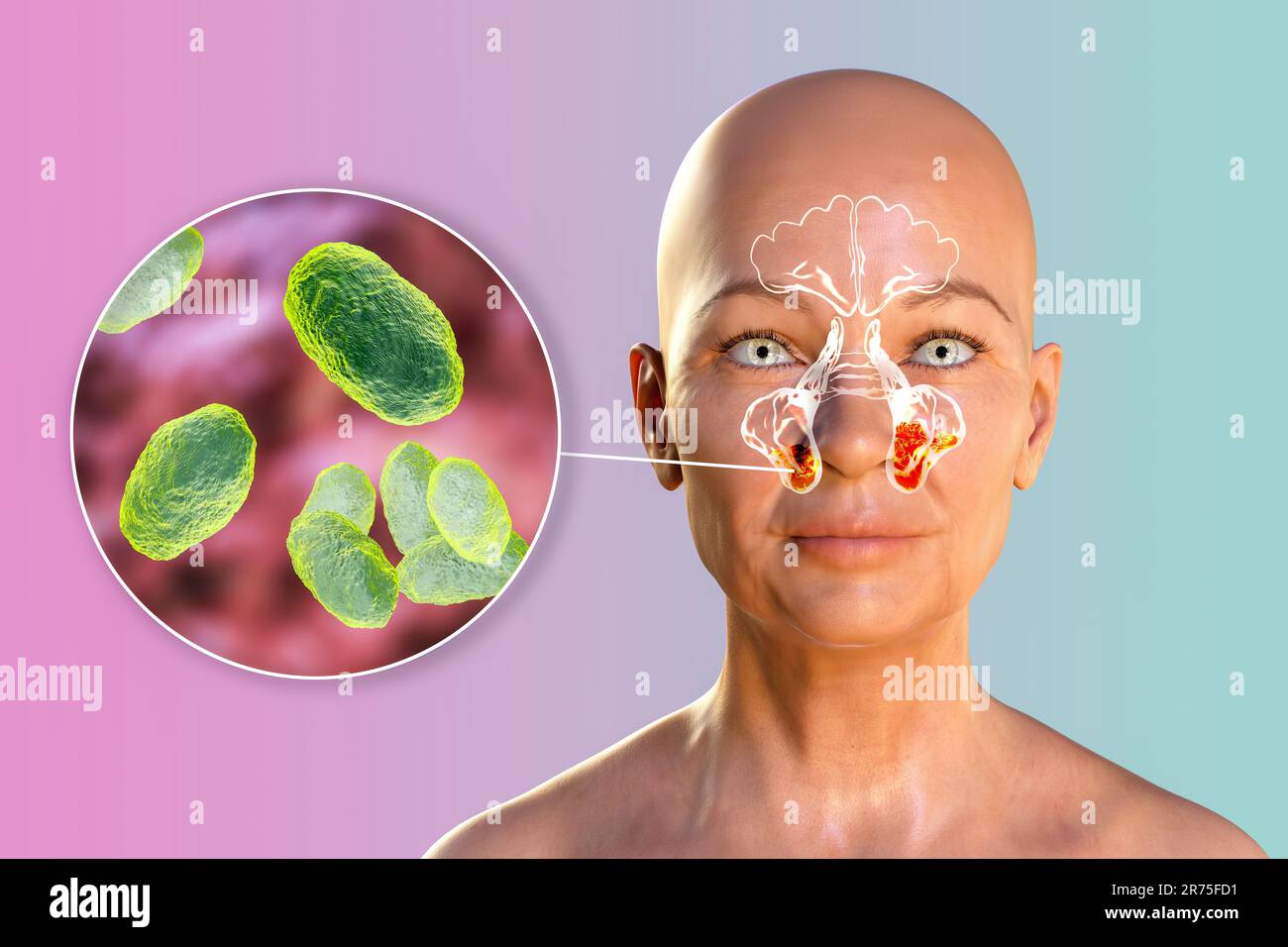 Haemophilus influenzae bacteria as a cause of sinusitis. Computer