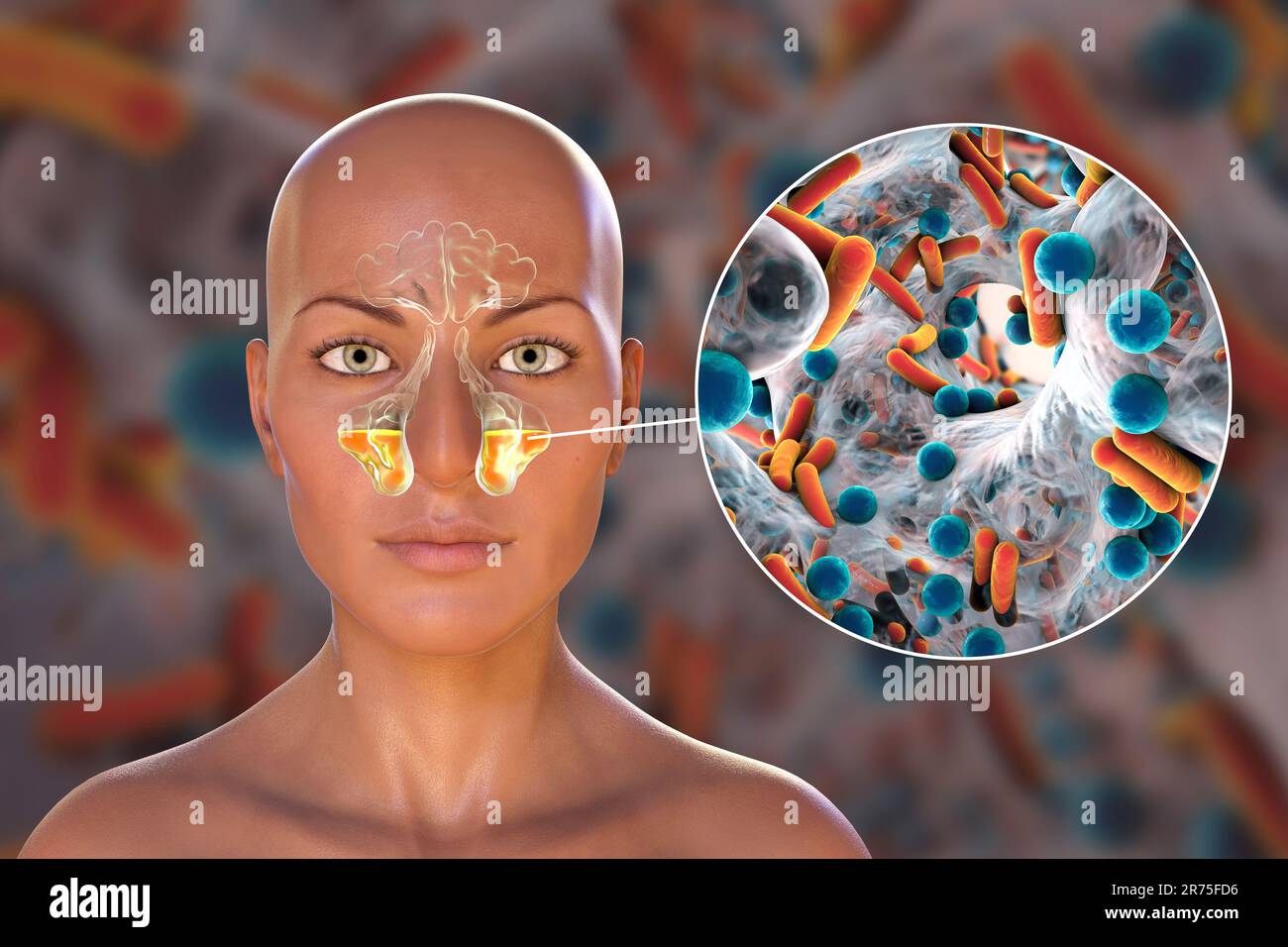 Sinusitis, inflammation of paranasal cavities. Computer illustration