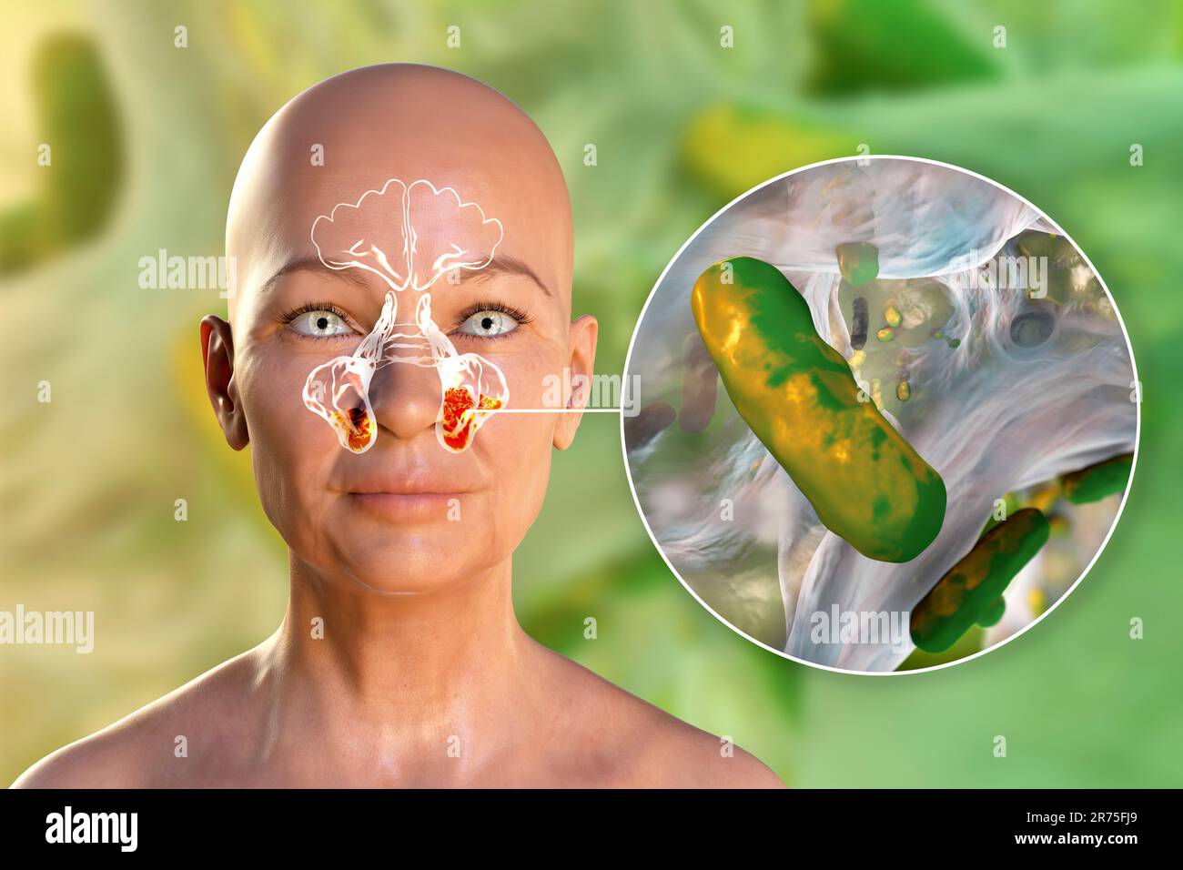 Pseudomonas aeruginosa bacteria as a cause of sinusitis. Computer