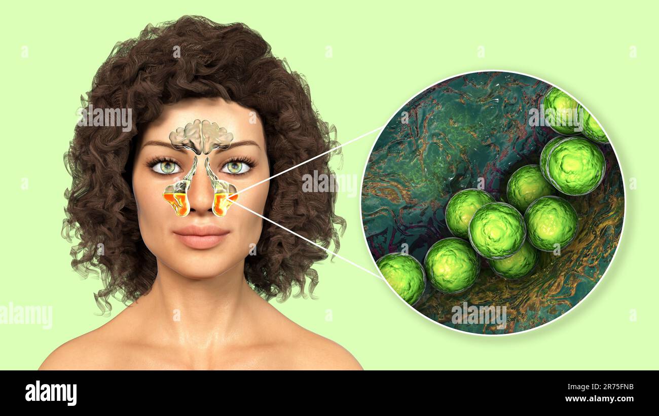 Streptococcus pyogenes bacteria and other streptococci as a cause of