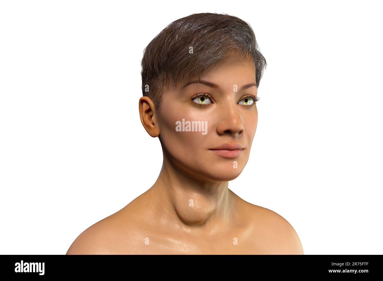 Thyroid gland tumour, computer illustration Stock Photo Alamy