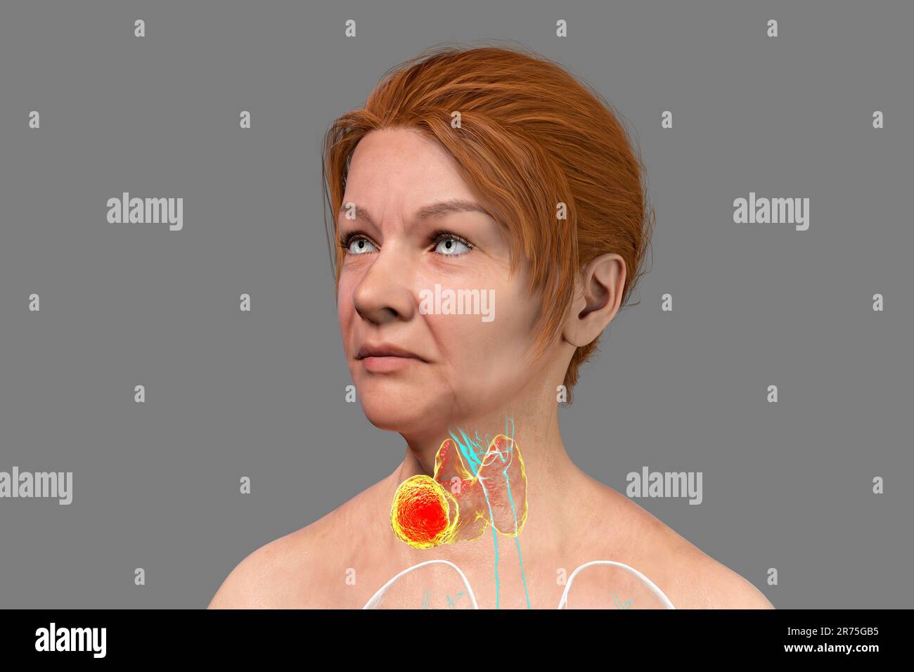 Thyroid gland tumour, computer illustration Stock Photo Alamy