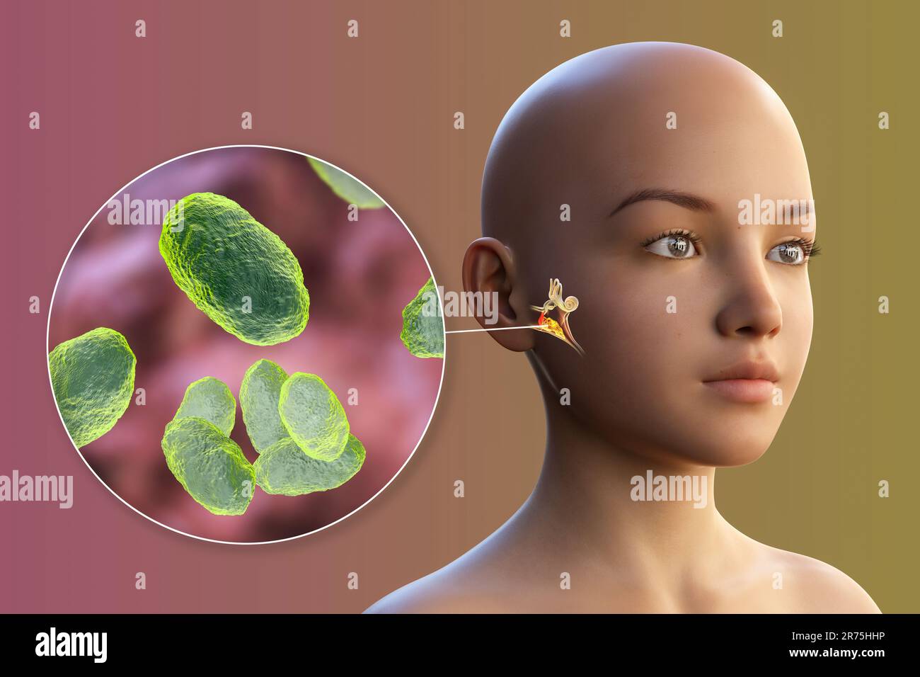 Otitis media ear infection caused by Haemophilus influenzae bacteria