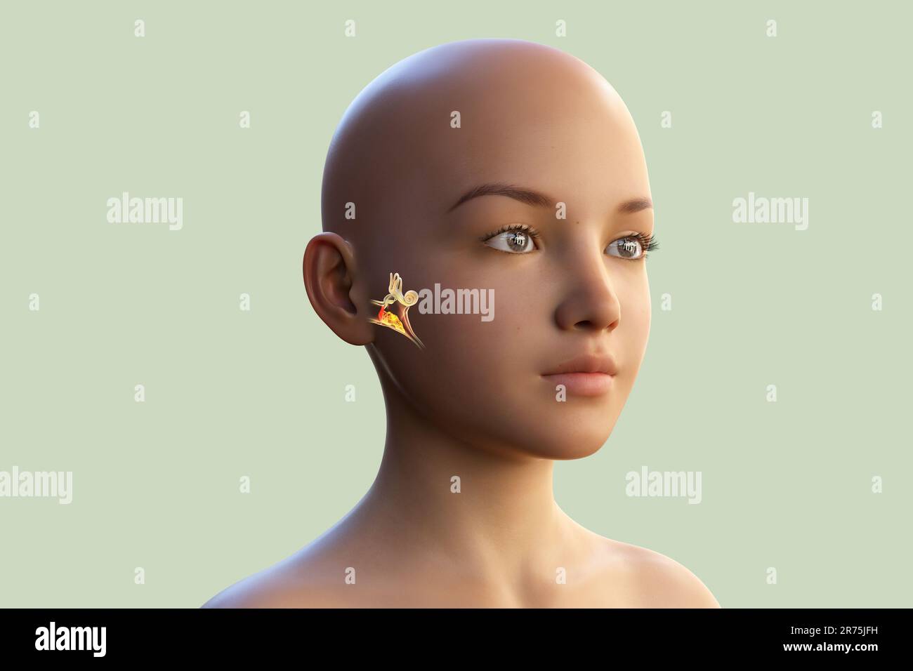 Otitis media, a group of inflammatory diseases of the middle ear. Computer illustration showing a girl with highlighted structures of the middle and i Stock Photo