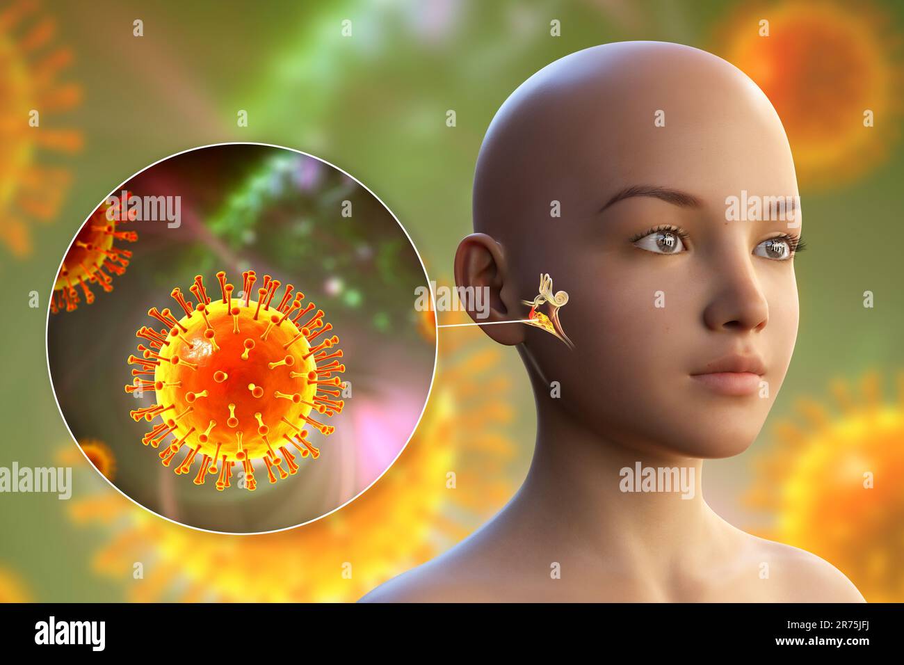 Viral otitis media, a group of inflammatory diseases of the middle ear