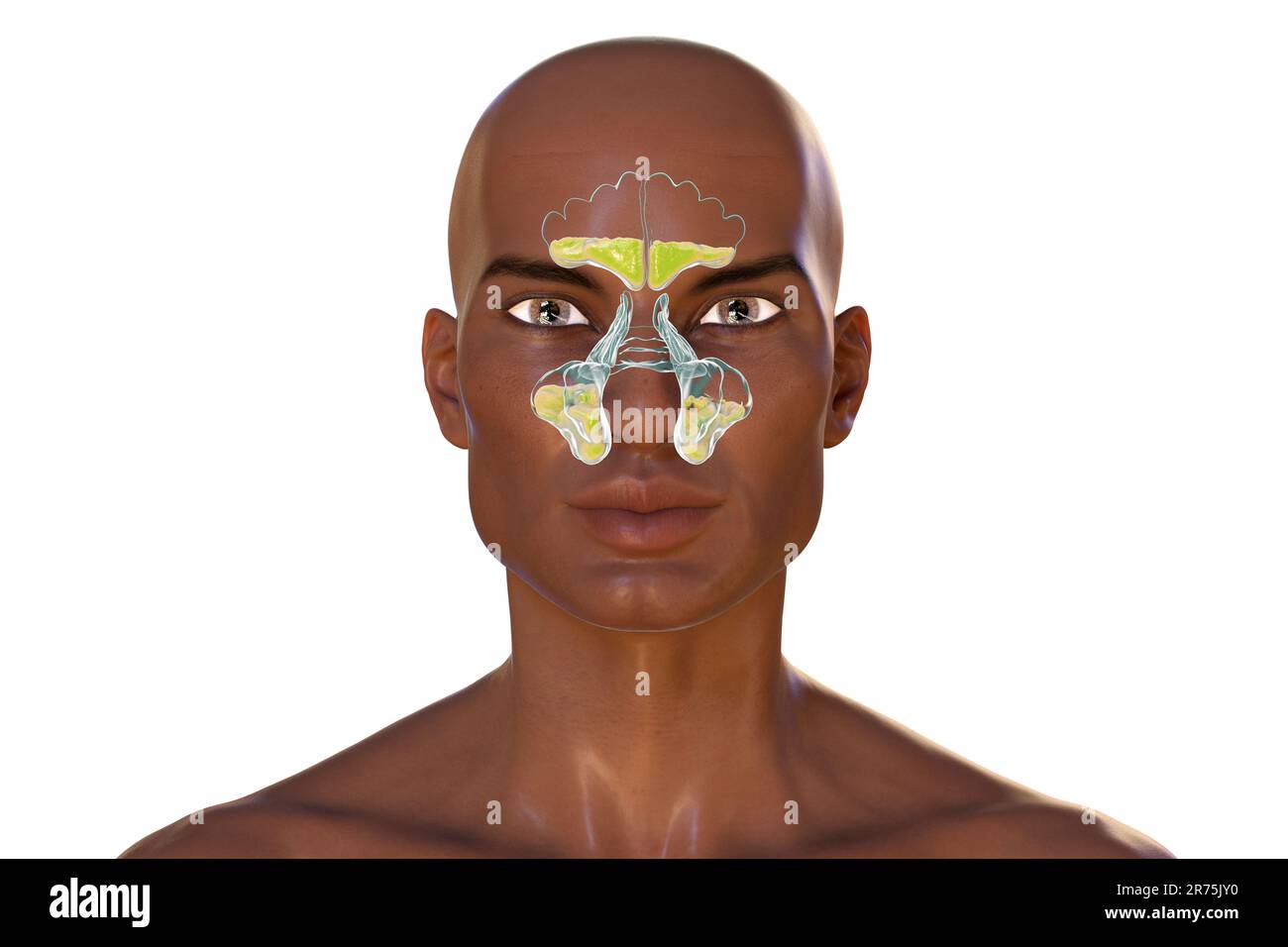 Sinusitis, computer illustration. The sinuses are membranelined air
