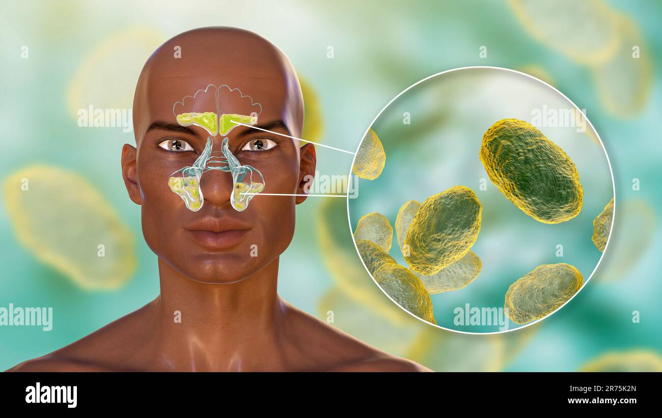 Bacterial sinusitis, computer illustration. The sinuses are membrane ...