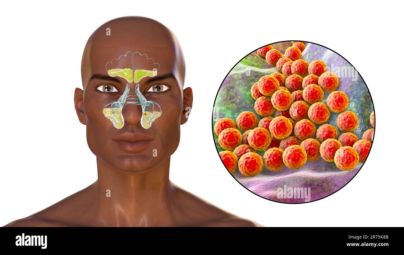 Bacterial sinusitis, computer illustration. The sinuses are membrane