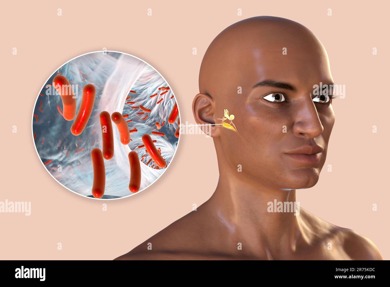 Otitis media, a group of inflammatory diseases of the middle ear