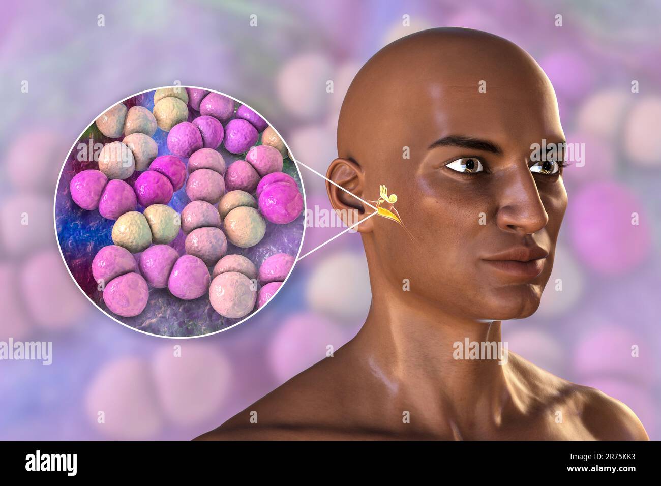 Otitis media ear infection caused by Streptococcus pneumoniae bacteria