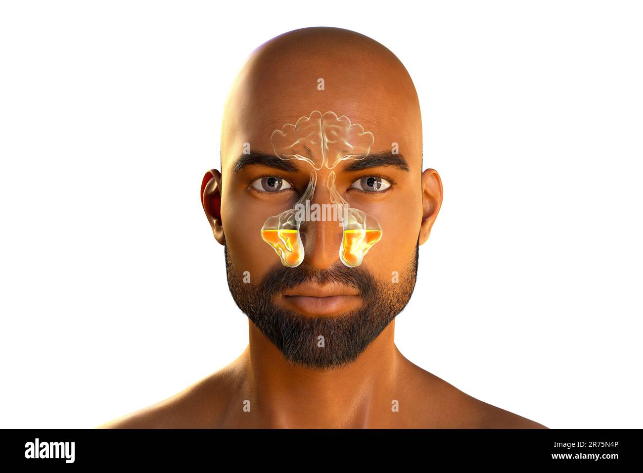 Sinus infection, or sinusitis, computer illustration. The sinuses are ...