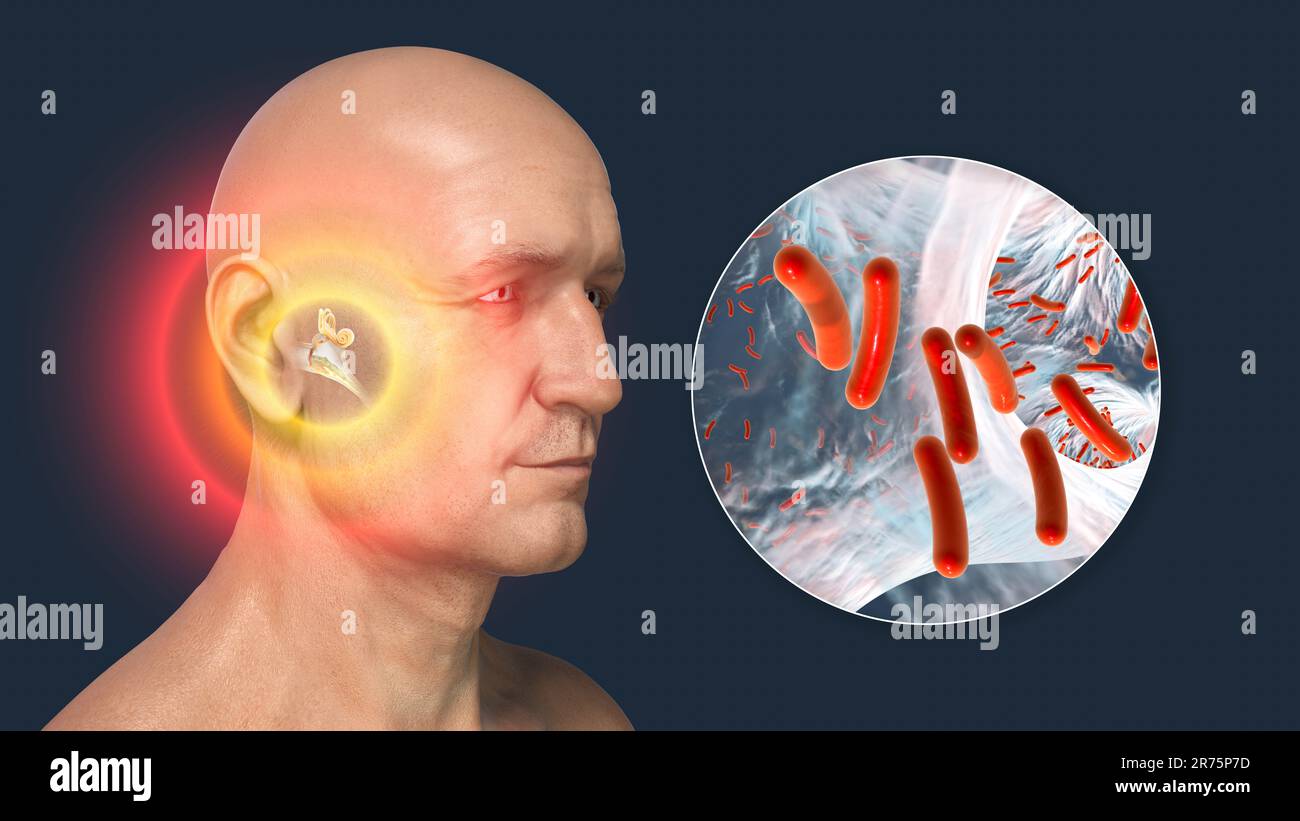 Otitis media, a group of inflammatory diseases of the middle ear. Computer illustration showing a man with highlighted structures of the middle and in Stock Photo