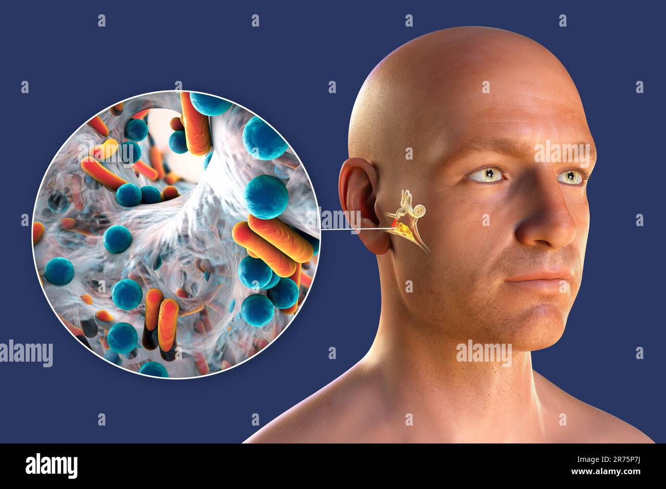 Otitis media, a group of inflammatory diseases of the middle ear. Computer illustration showing a man with highlighted structures of the middle and in Stock Photo