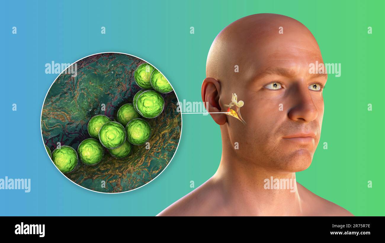 Otitis media ear infection caused by Streptococcus pyogenes bacteria