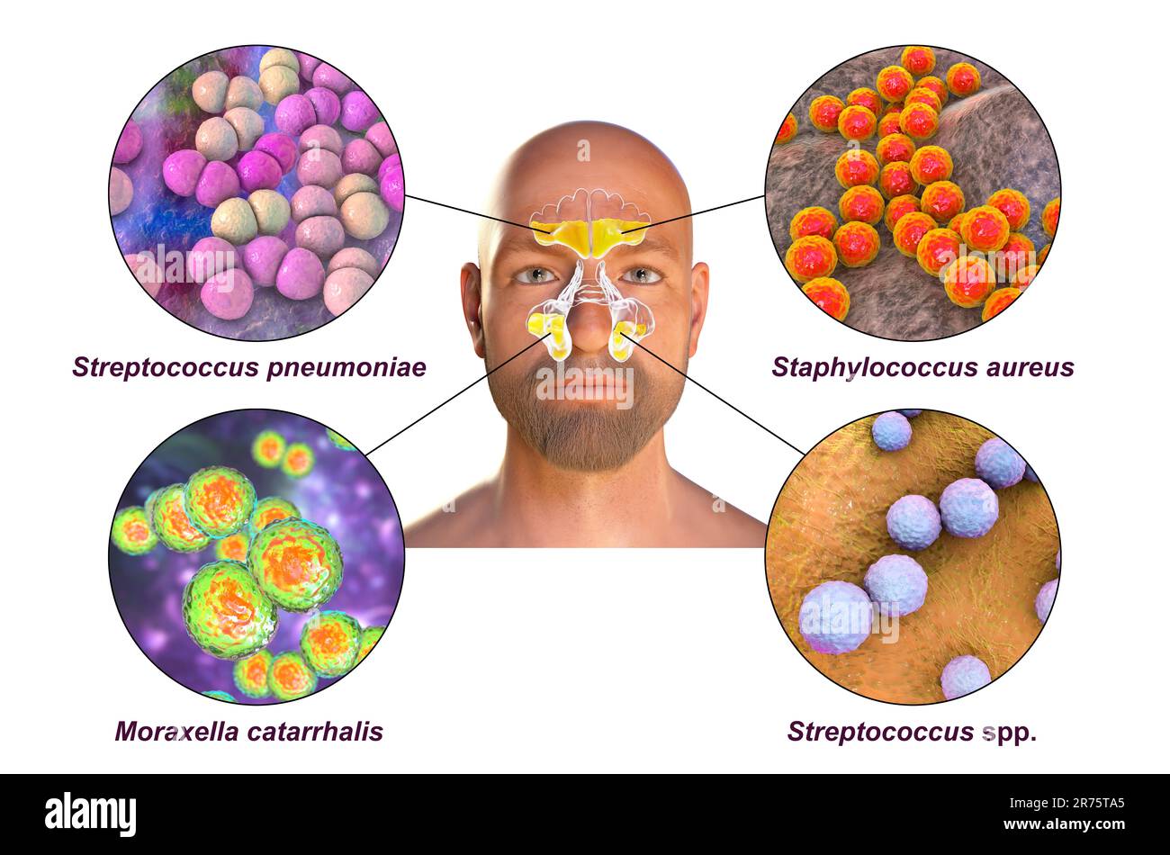 Rhinosinusitis in a man and bacteria that cause sinusitis. Streptococcus pneumoniae, Staphylococcus aureus, Moraxella catarrhalis, and Streptococcus p Stock Photo