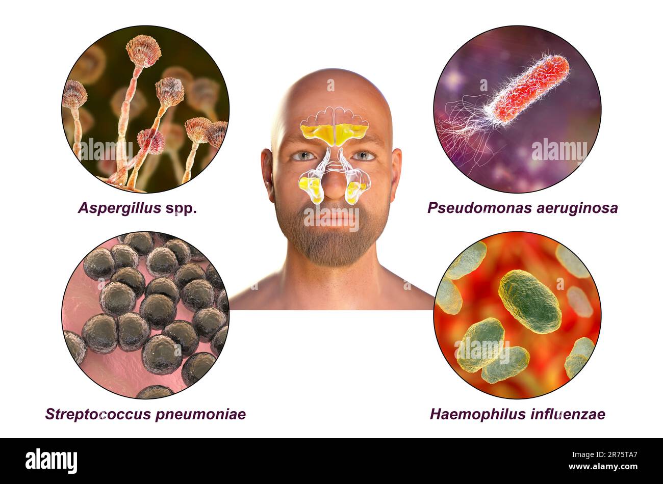 Rhinosinusitis and microorganisms that cause sinusitis, fungi Aspergillus, bacteria Pseudomonas aeruginosa, Streptococcus pneumoniae, and Haemophilus Stock Photo