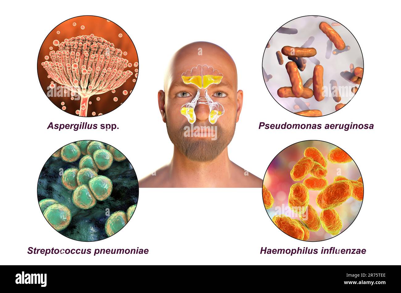 Rhinosinusitis and microorganisms that cause sinusitis, fungi Aspergillus, bacteria Pseudomonas aeruginosa, Streptococcus pneumoniae, and Haemophilus Stock Photo