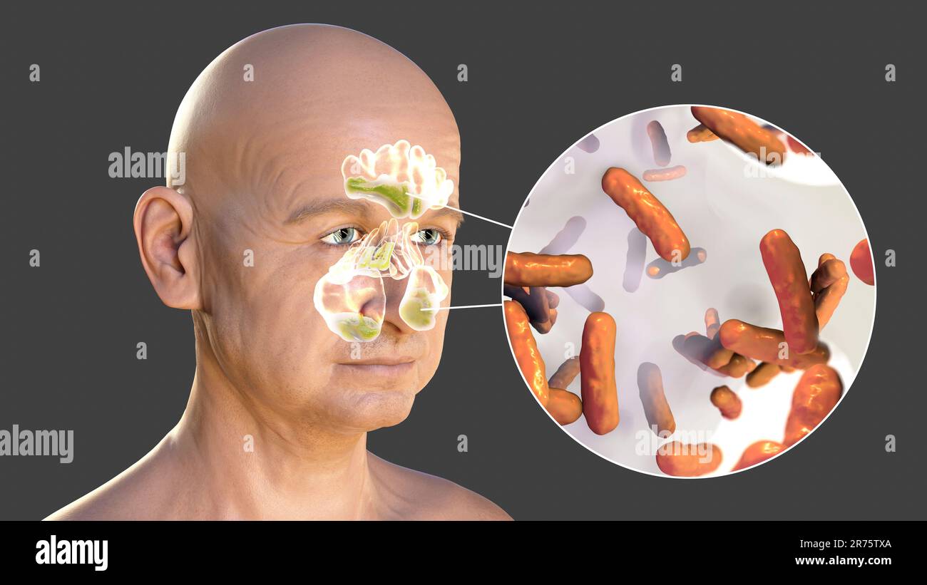 Pseudomonas aeruginosa bacteria as a cause of sinusitis. Computer