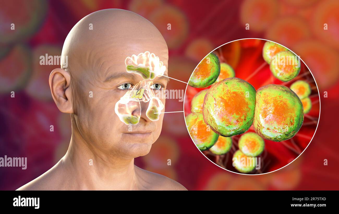 Moraxella catarrhalis bacteria as a cause of sinusitis. Computer ...