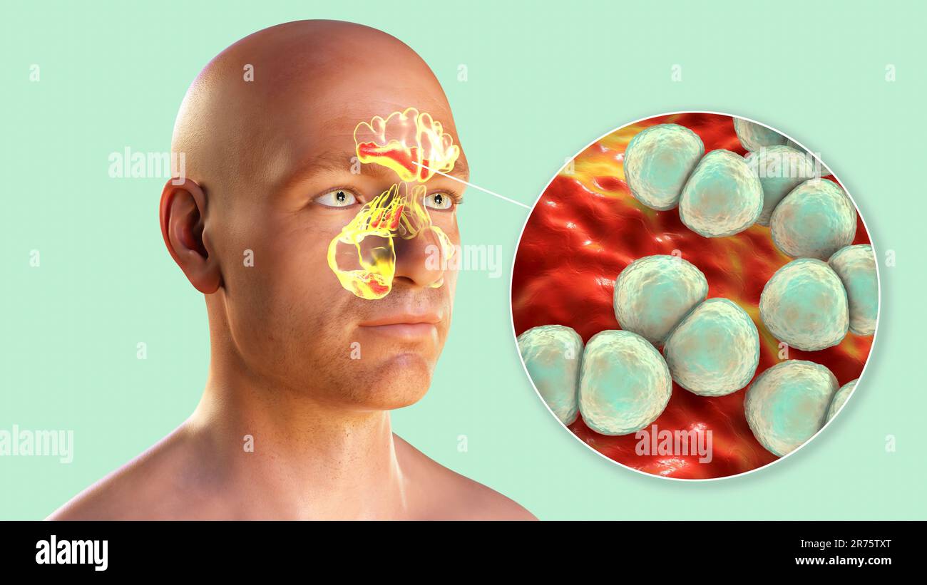 Streptococcus pneumoniae bacteria as a cause of sinusitis. Computer illustration showing inflammation of maxillary sinuses and close-up view of pneumo Stock Photo