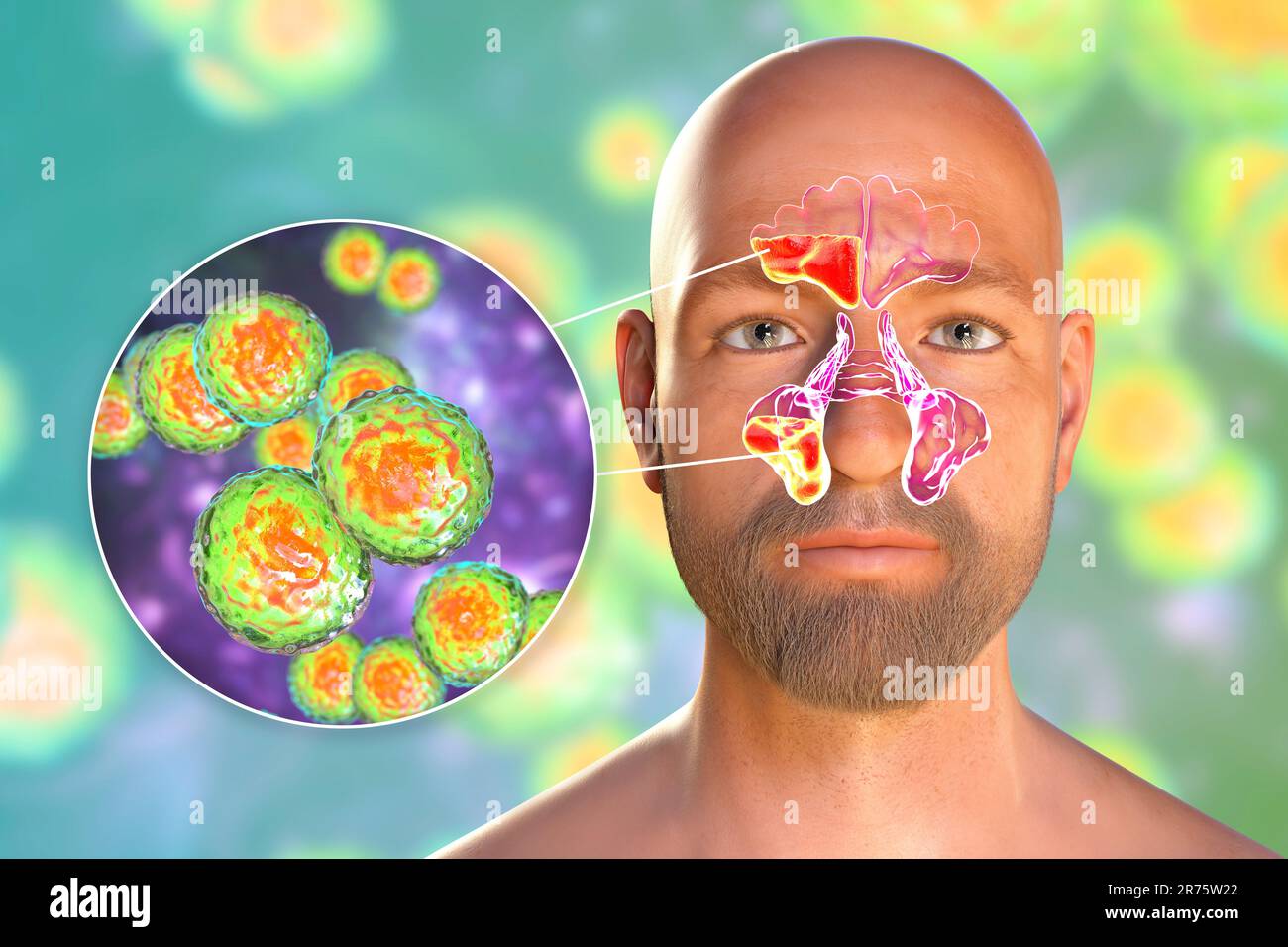Moraxella catarrhalis bacteria as a cause of sinusitis. Computer illustration showing