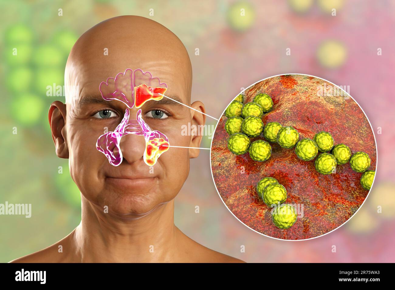 Streptococcus pyogenes bacteria as a cause of sinusitis. Comouter illustration showing purulent inflammation of frontal and maxillary sinuses and clos Stock Photo