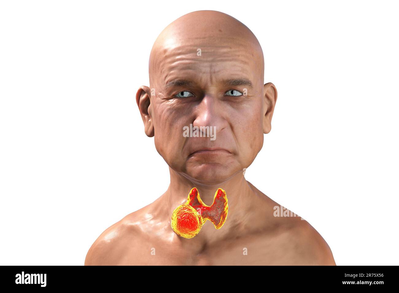 Thyroid gland tumour, computer illustration Stock Photo Alamy
