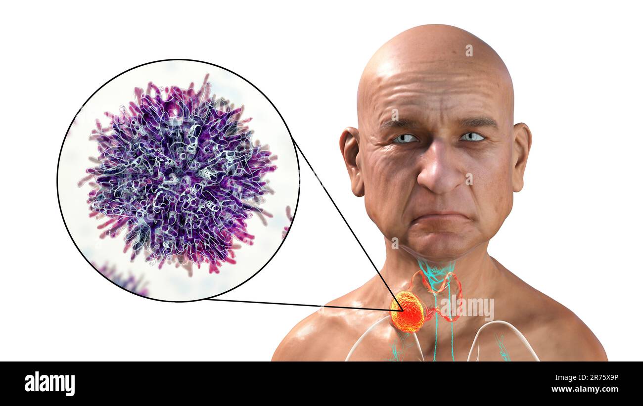 Thyroid gland cancer with closeup view of cancer cells, computer