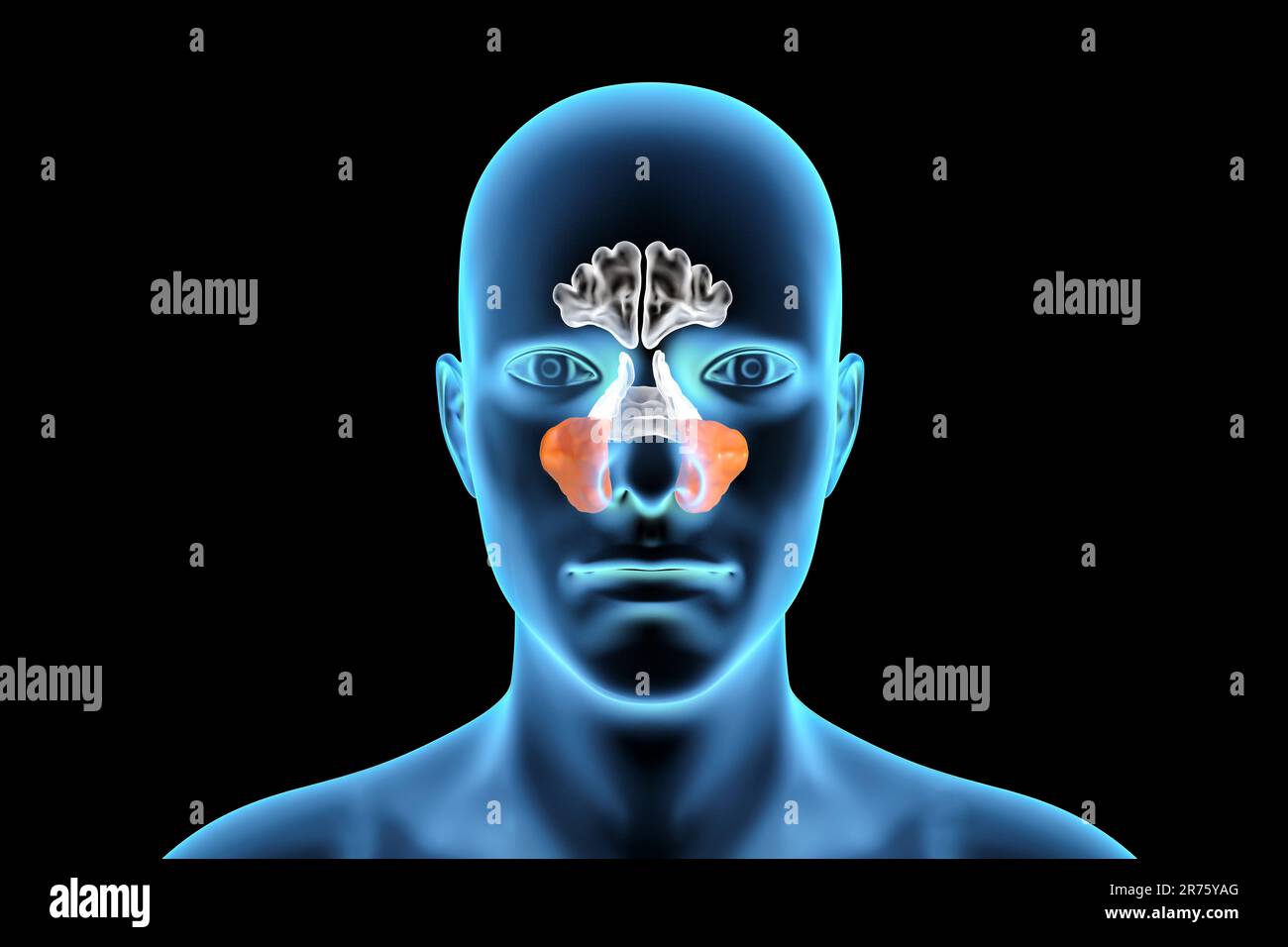 Human paranasal sinuses, computer illustration. The sinuses are
