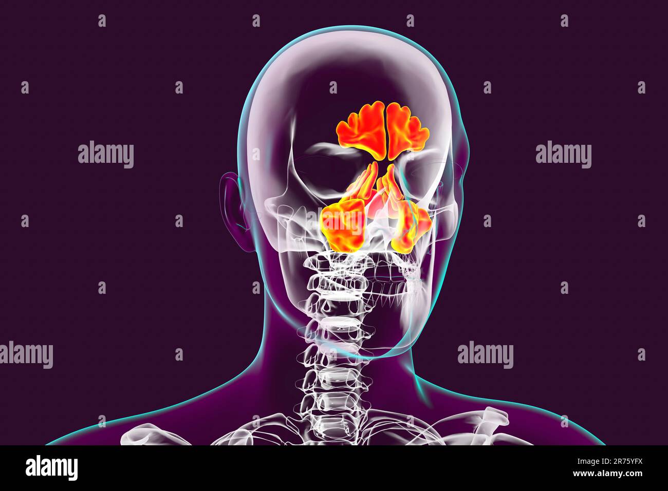 Human paranasal sinuses, computer illustration. The sinuses are