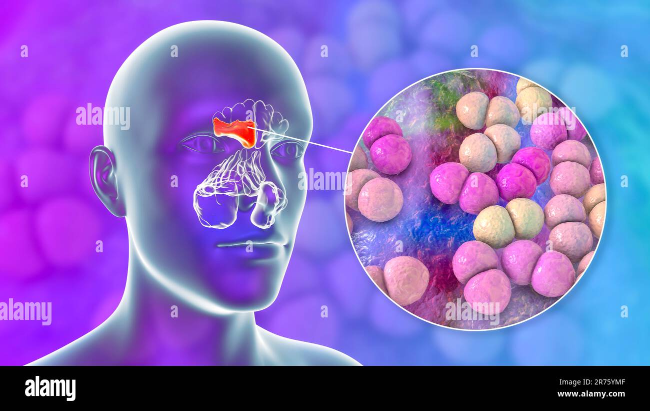 Bacterial sinusitis, computer illustration. The sinuses are membrane