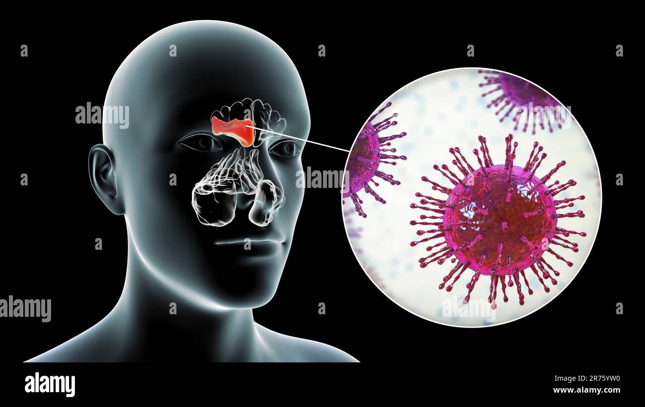 Viral sinusitis, computer illustration. The sinuses are membranelined