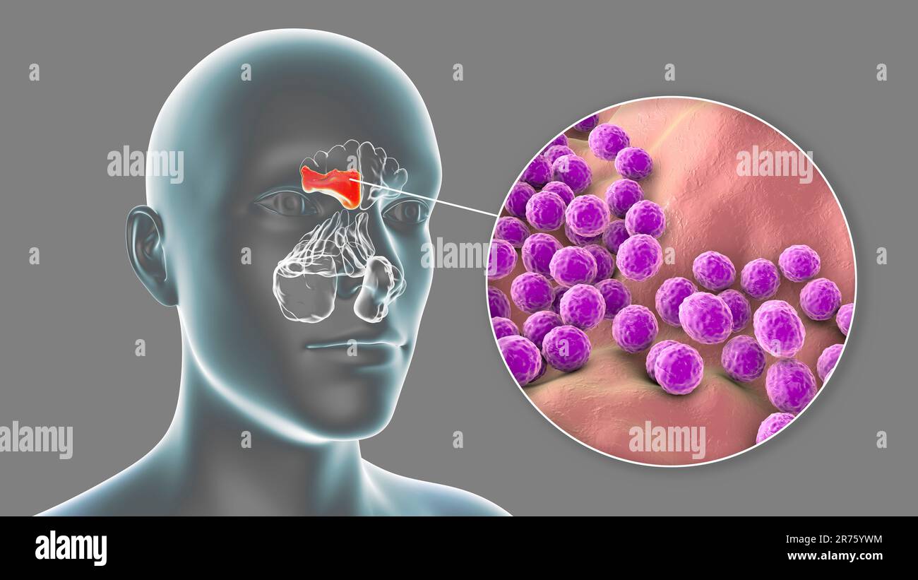 Bacterial sinusitis, computer illustration. The sinuses are membrane