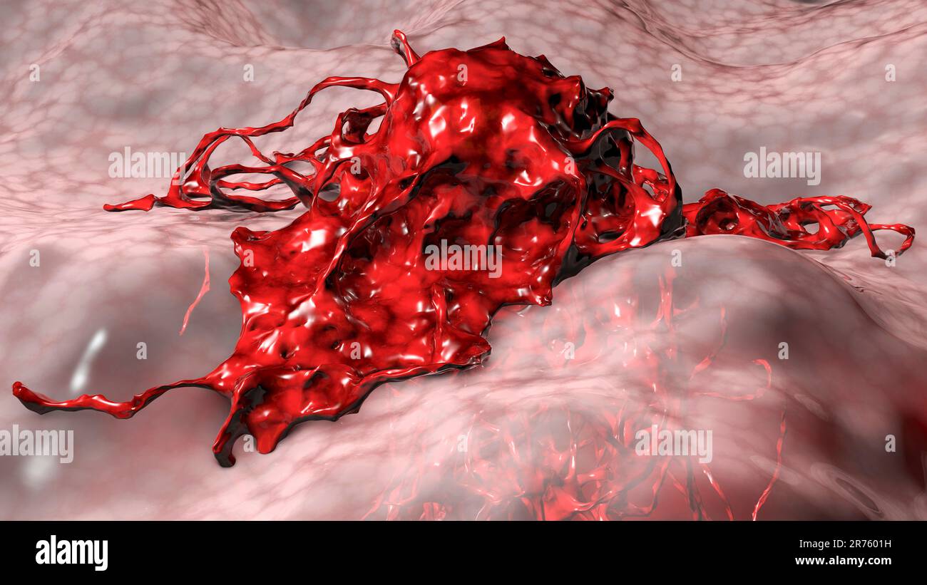 Tissue Growing Cancer cell growing and spreading into surrounding tissues, computer ...