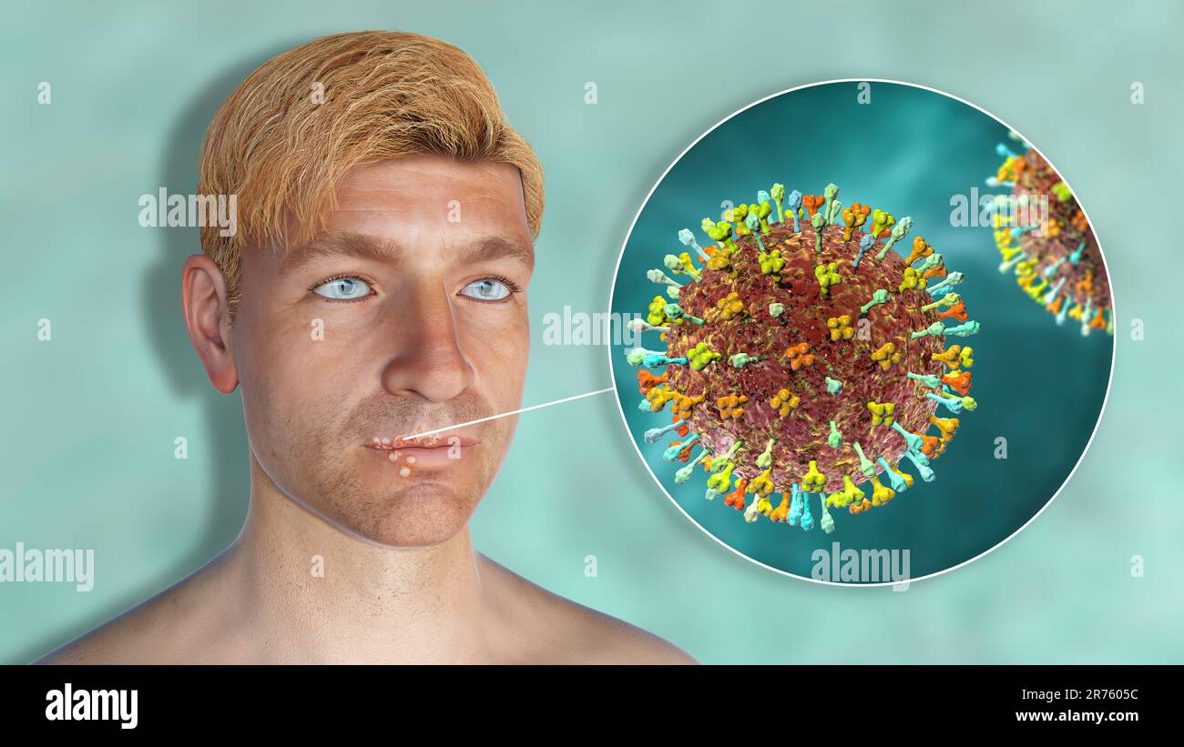 Cold sore on the lip of a man and closeup view of herpes simplex viruses, computer illustration. Cold sores are painful, fluid-filled blisters caused Stock Photo