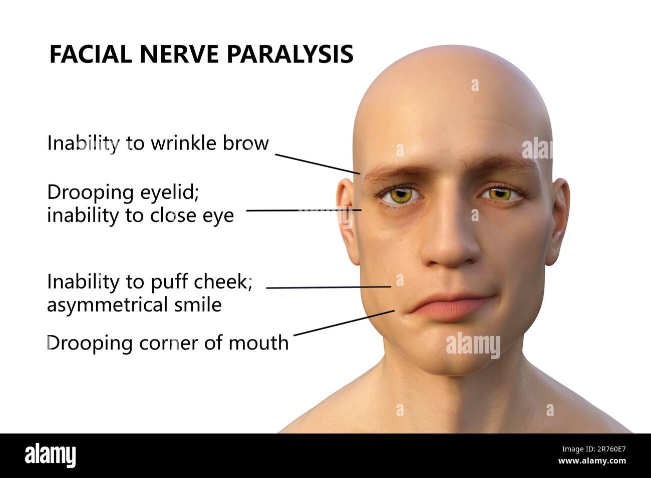 Bell's palsy, a unilateral facial paralysis, computer illustration. The