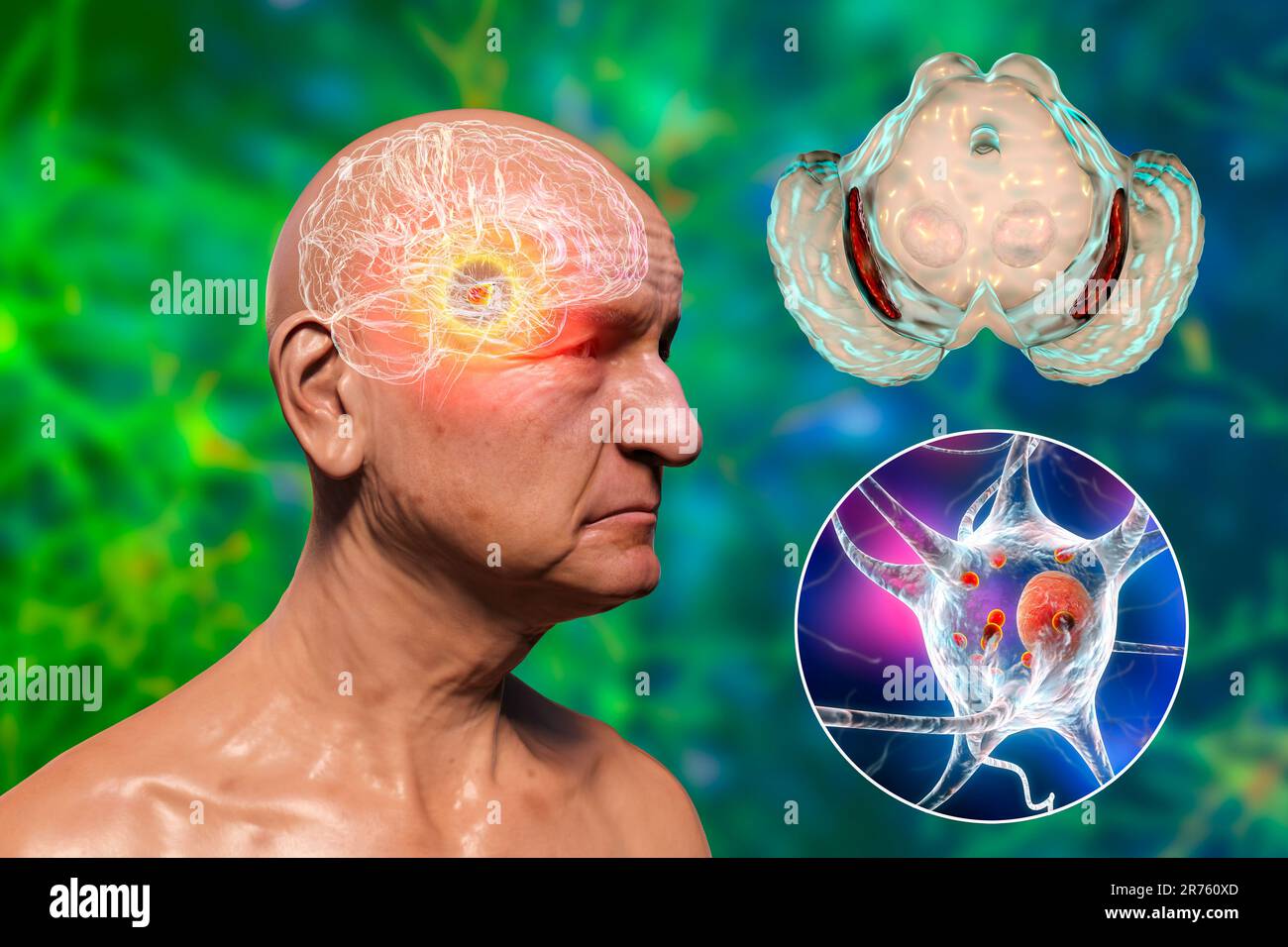 Substantia nigra. Computer illustration showing a degenerated substantia nigra in Parkinson's disease. The substantia nigra plays an important role in Stock Photo