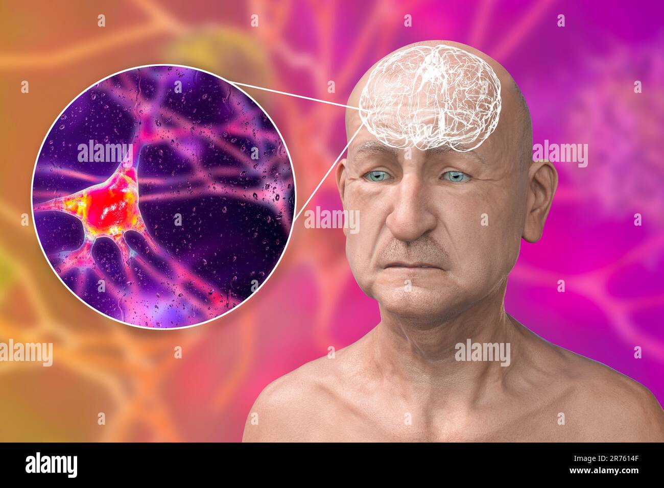 Dementia, conceptual computer illustration showing an elderly person