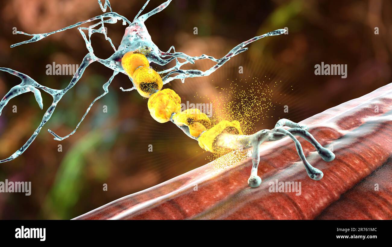 Demyelination of neuron, the damage of the neuron myelin sheath seen in ...