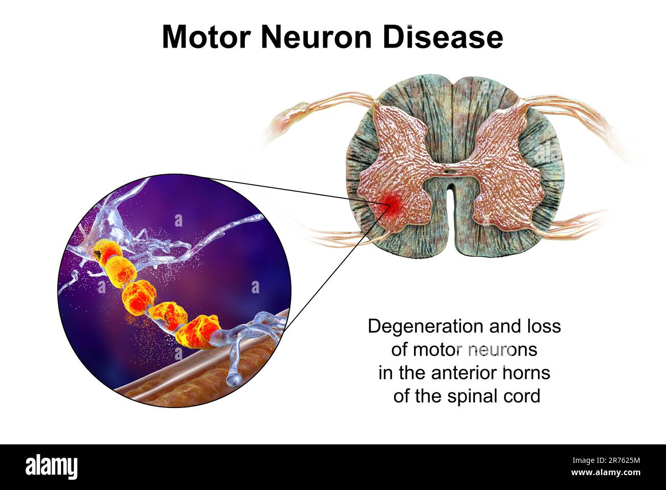 Motor neuron diseases, computer illustration showing degeneration of