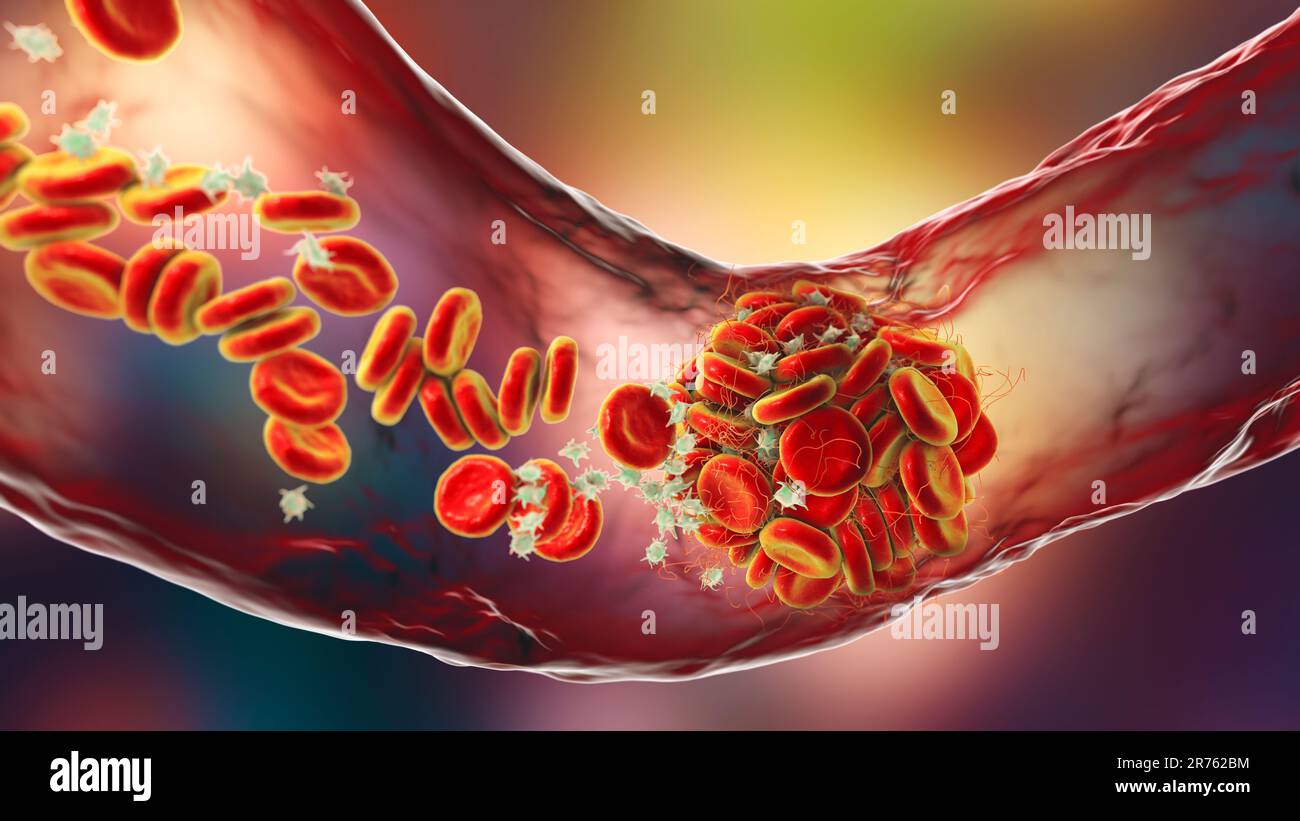 Blood clot, computer artwork Stock Photo Alamy