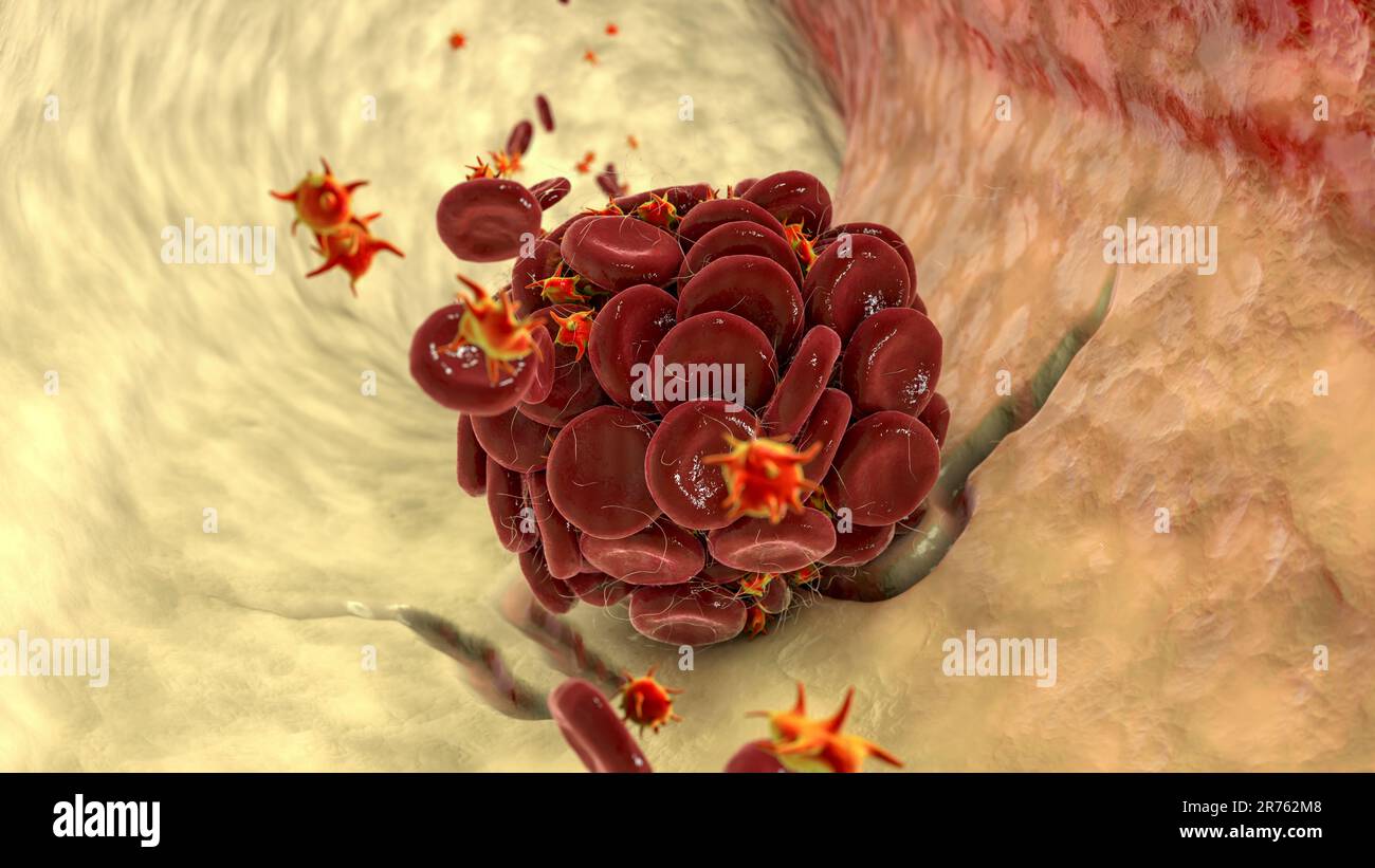 Blood clot in damaged blood vessel made of red blood cells, platelets and fibrin protein strands