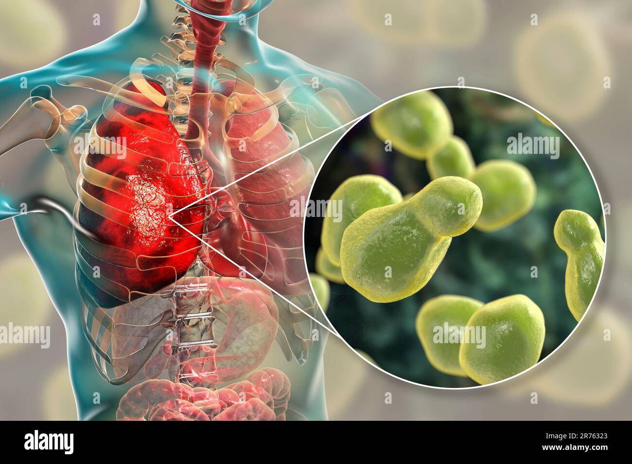 Pulmonary cryptococcosis, invasion of a lung tissue by yeast fungi Cryptococcus neoformans with close-up view of the fungi, computer illustration. Stock Photo