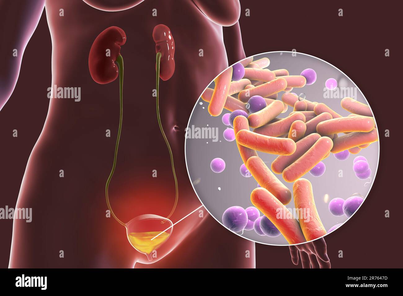 Bacterial cystitis, illustration. Cystitis (inflammation of the bladder