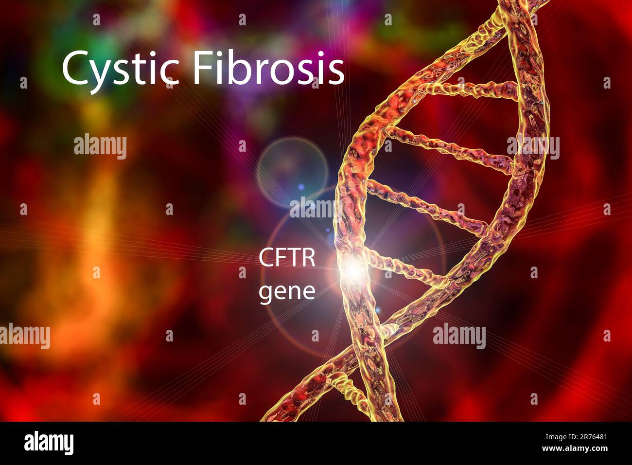 Illustration of cystic fibrosis, a hereditary condition (also called mucoviscidosis) results in the airways (bronchi) being clogged with mucus, causin Stock Photo