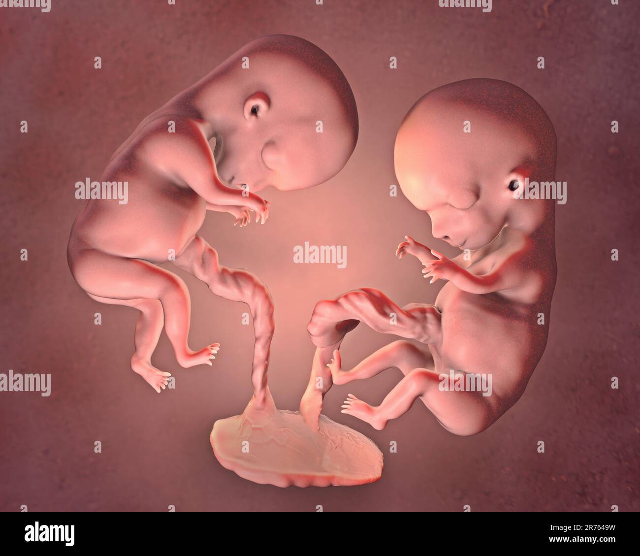 Multiple pregnancy, illustration. Monozygotic twins in the uterus